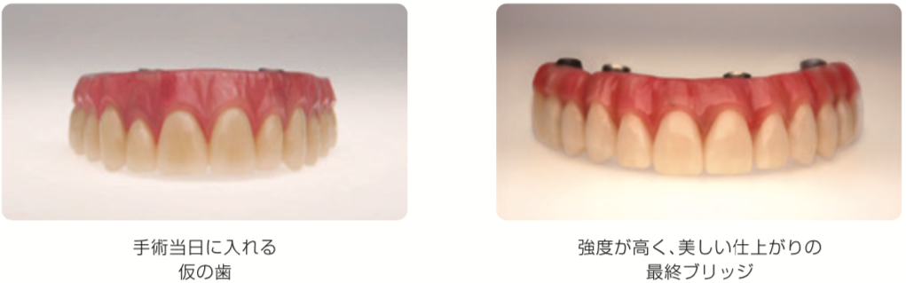 All-on-4 の仮歯と最終補綴物