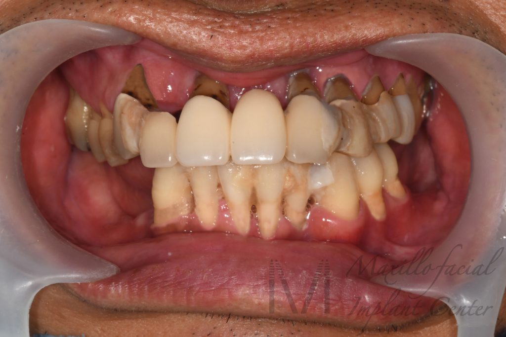 歯がぐらつく | 入れ歯が合わない | 噛むと痛い 口腔内写真