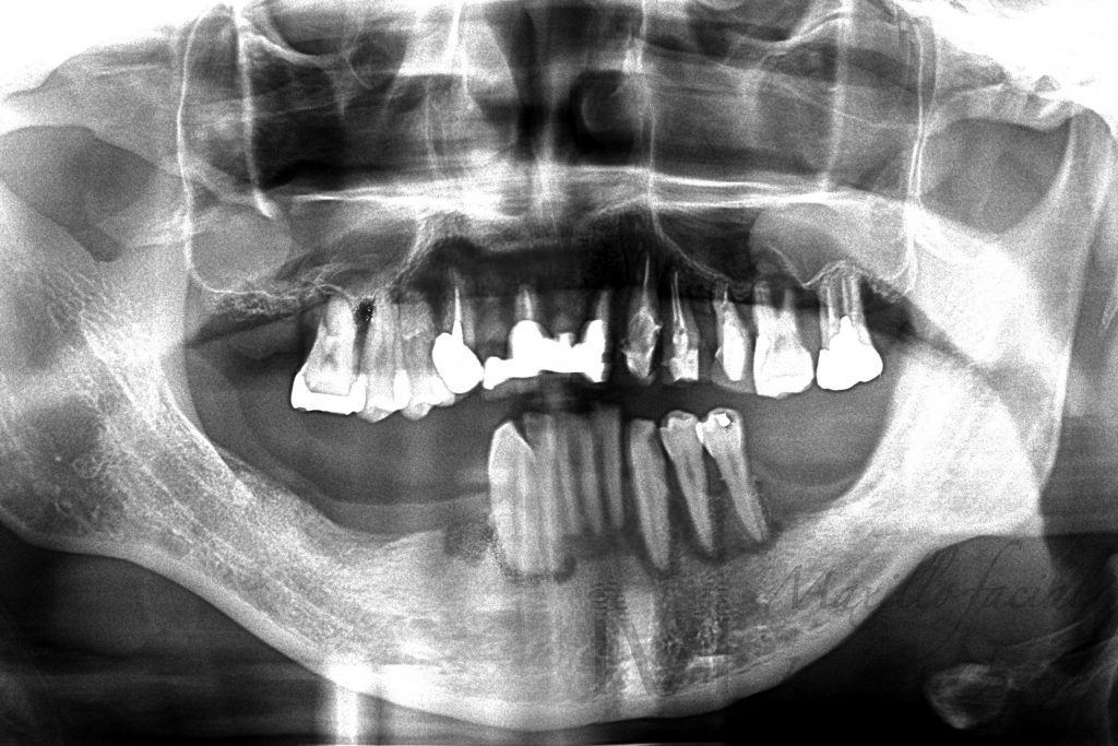 歯がぐらつく | 入れ歯が合わない | 噛むと痛い レントゲン画像