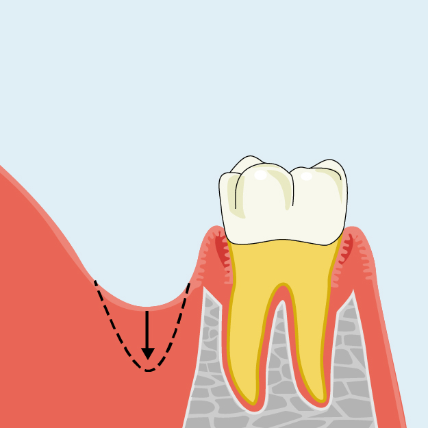 歯肉歯槽粘膜形成術　口腔前庭拡張術