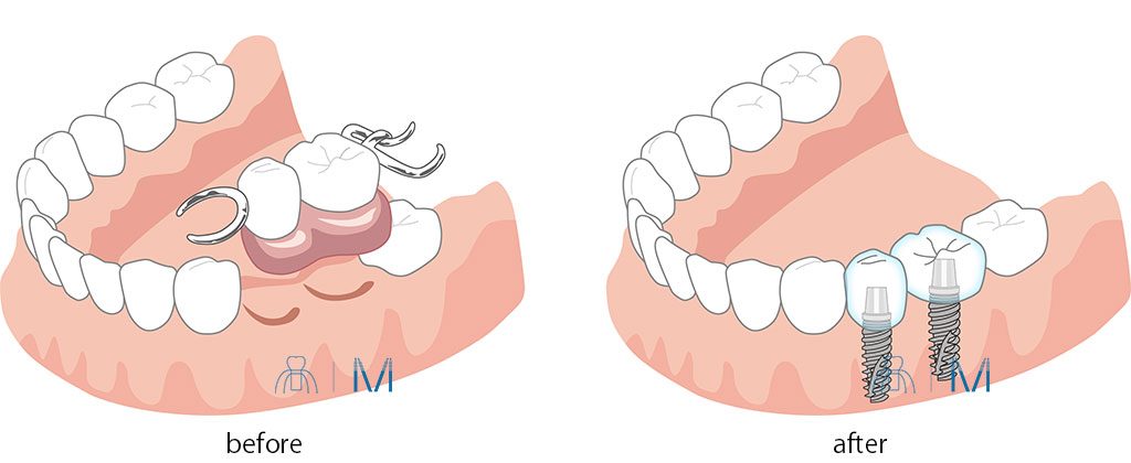 ２本分の部分 入れ歯 を インプラント  に変える