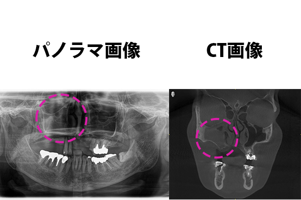 術前レントゲン画像